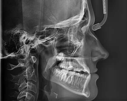 Телерентгенография – снимок черепа в прямой и боковой проекциях