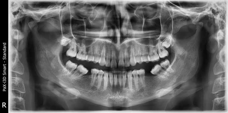 Ортопантомографія (панорамний знімок)