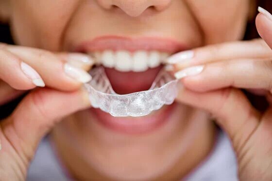 Выравнивание зубов и исправление прикуса