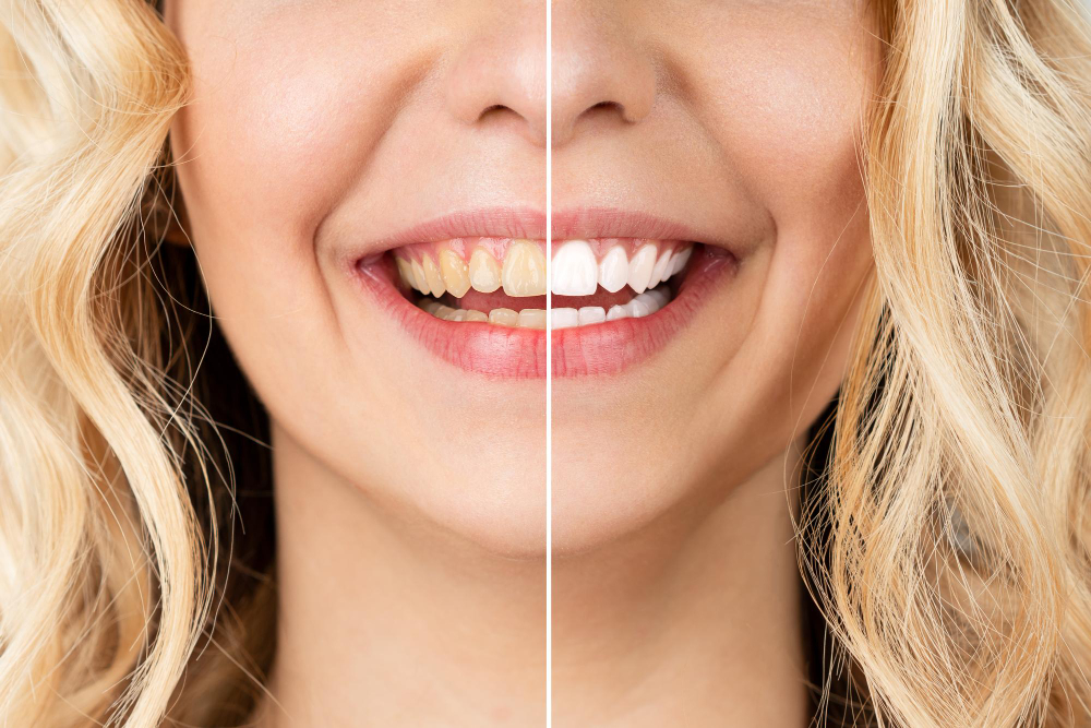 Изображение показывает зубы до и после установки виниров