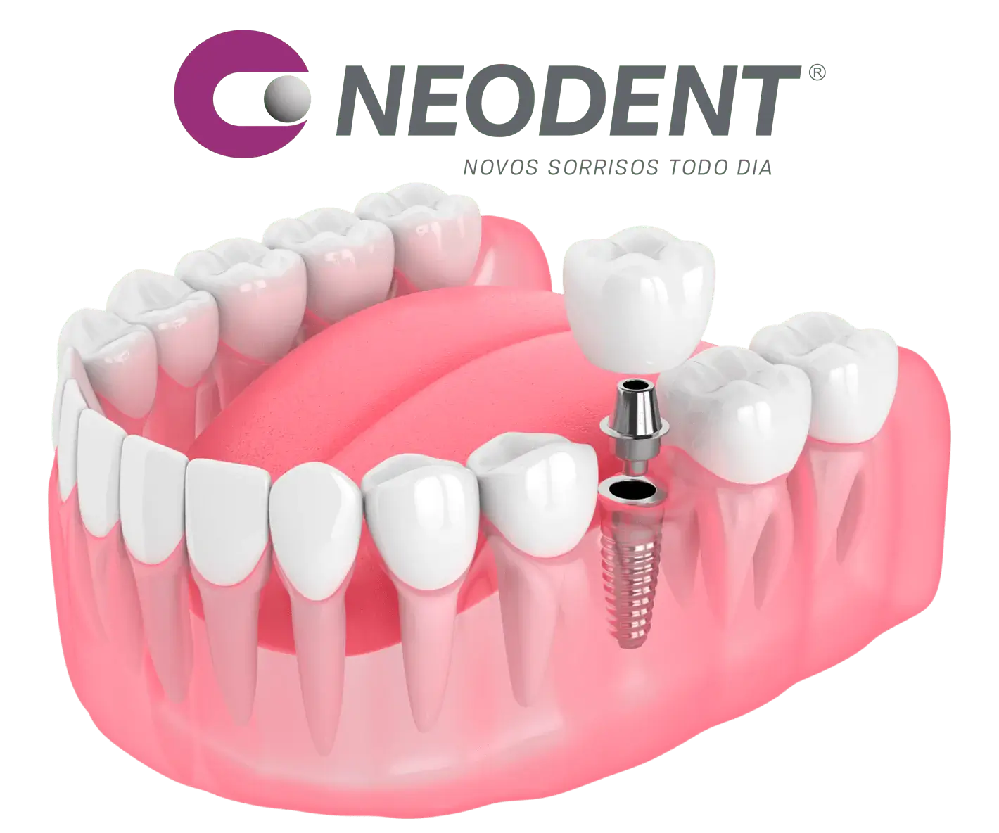 Імпланти NeoDent (Неодент)